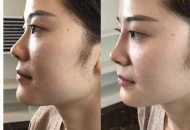 玻尿酸填充鼻子的对比图.