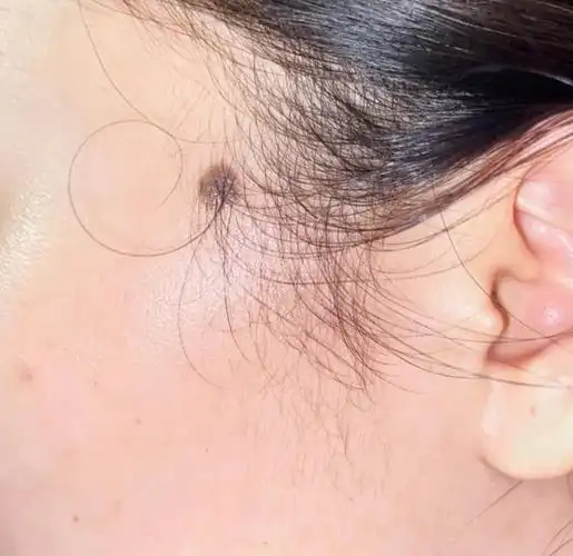 黑毛痣的恶变风险:哪些部位需要特别关注?