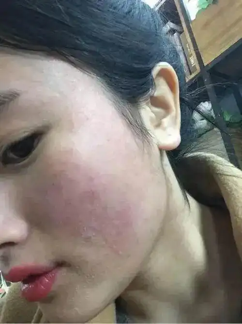 杏林微科普一起来了解一下皮肤过敏