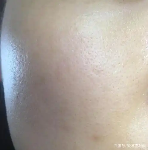 3,老化型毛孔粗大:这是因为年龄和保养不当导致,脸颊会出现毛孔粗大