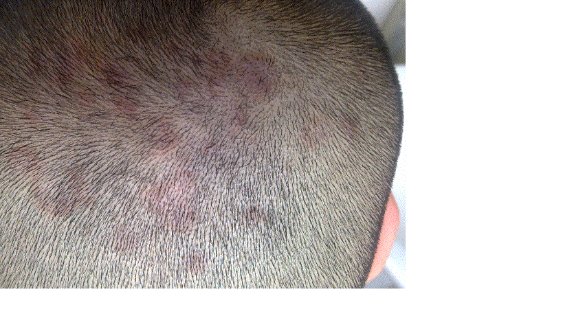 头皮上长有红斑