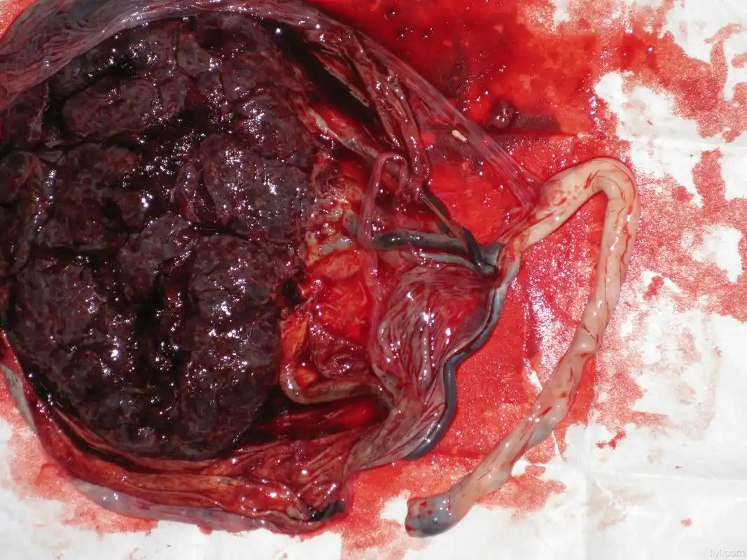 帆状胎盘不知道大家见过没