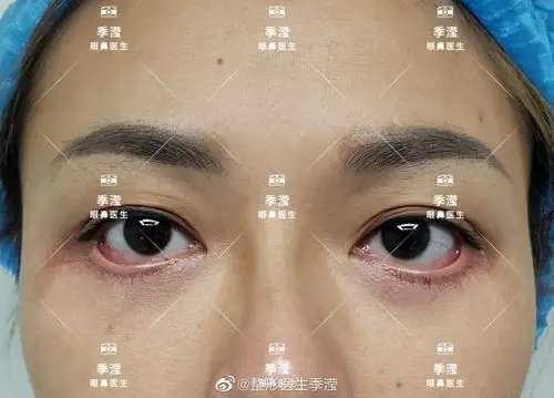 下眼睑退缩外翻矫正案例时程一年左右