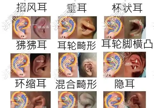 深圳有名耳朵形整形医院公布耳朵矫正费用分享