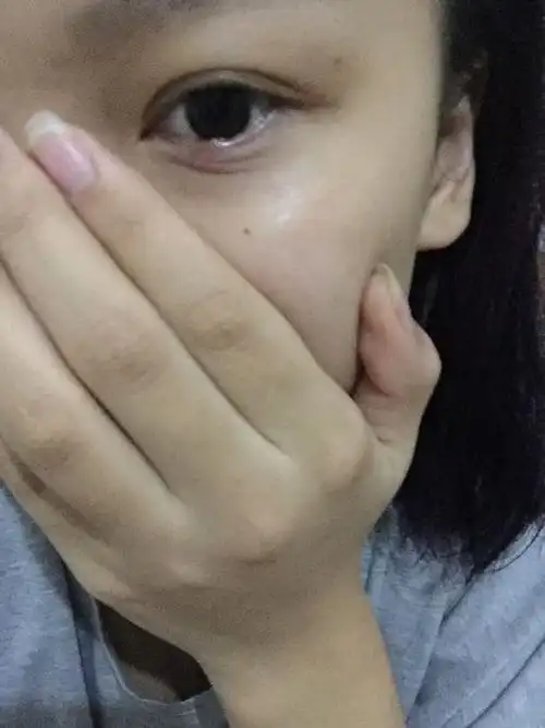 睡一觉起来眼睛下眼袋就长了个小白疙瘩,下眼袋也变得红肿,眨眼也有点