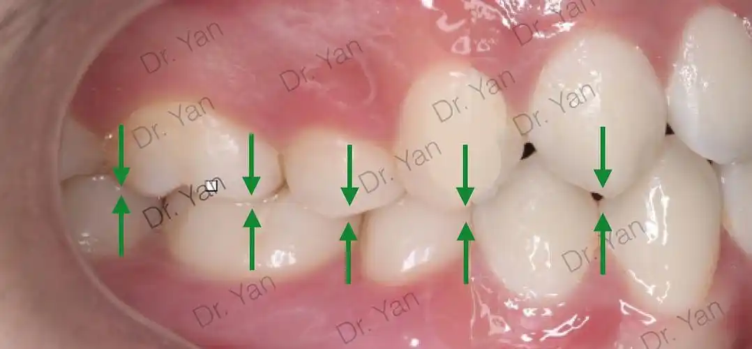 棍妹的皮笑肉不笑是不是因为咬合不正