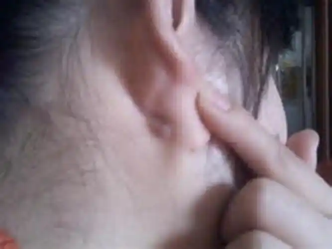 脖子淋巴瘤早期图片_有来医生