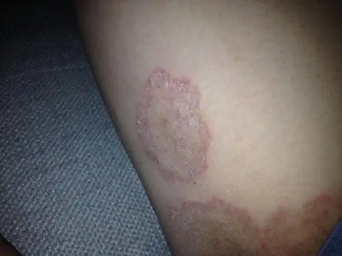 大腿内侧红的一团,痒,脱皮