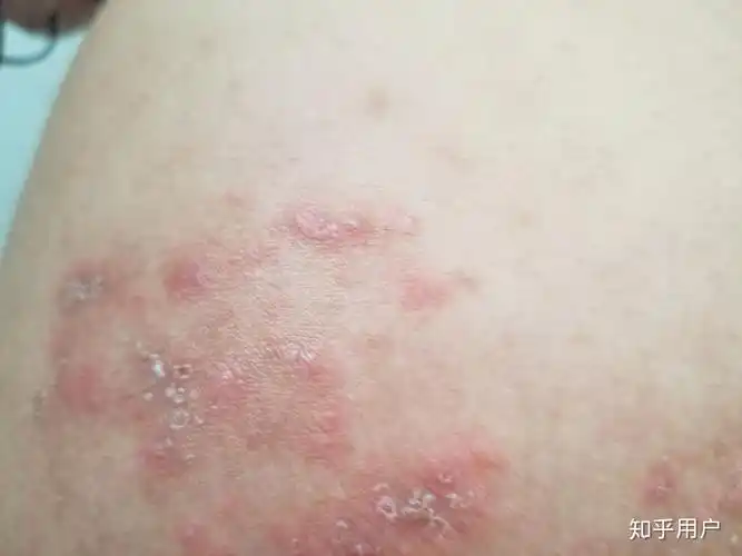 请问这是湿疹还是股藓有图慎入