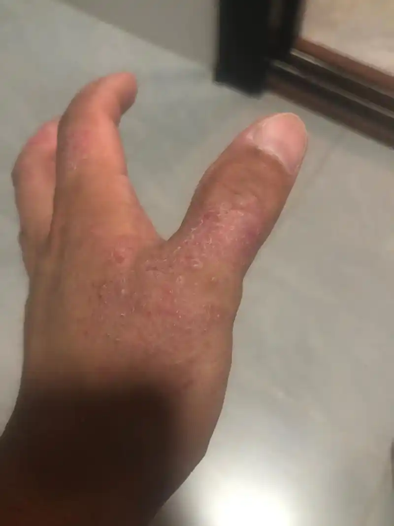 十几年的瓦工师傅烙下了这个皮肤过敏症状广大的网友们有没有什么好的