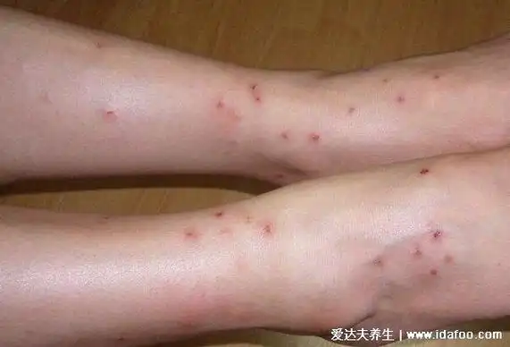 跳蚤咬的红疙瘩图片,呈直线形或三角形排列的疙瘩(附处理法)