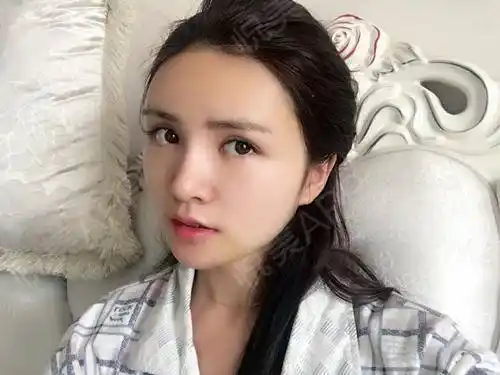 【自体脂肪填充全脸 术后第4天】