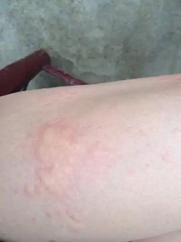 你好我今年26岁,最近老是皮肤过敏,全身一会就成下图这样了,不过过个