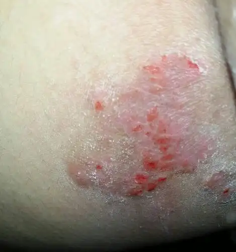 大腿内侧皮肤成这样,很痒,请问怎么解决,有两个月了