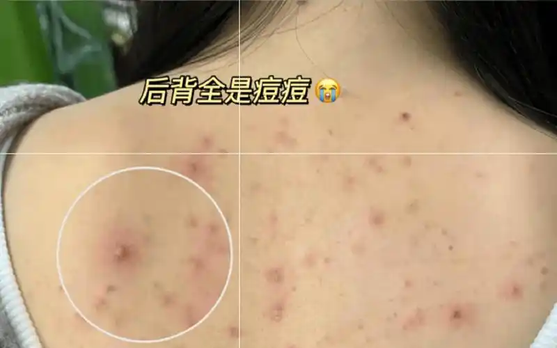 去后背痘竟然如此简单每天只需做好这两步顽固脓包痘洗洗就掉