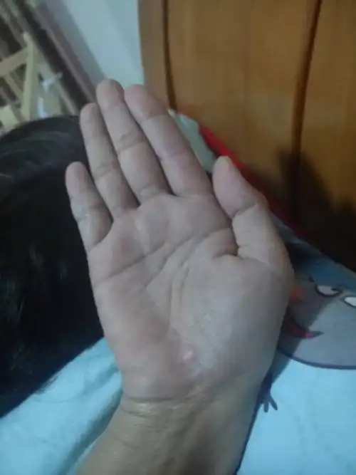 大鱼际青经明显,整个手掌发青