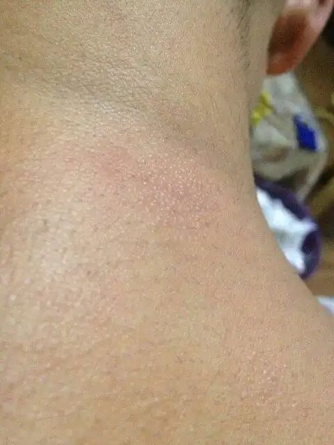 我最近脖子后面出现类似像皮肤癣一样的东西这是什么?