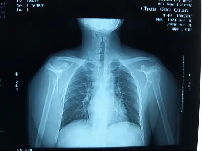 左肩锁关节脱位