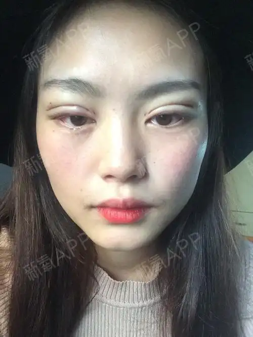 埋线双眼皮好不好_效果图_安哥v5埋线双眼皮术后第天_新氧美容整形