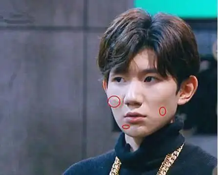 tfboys未修图曝光, 满脸痘痘如路人