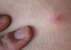 外阴长疖子的症状图片