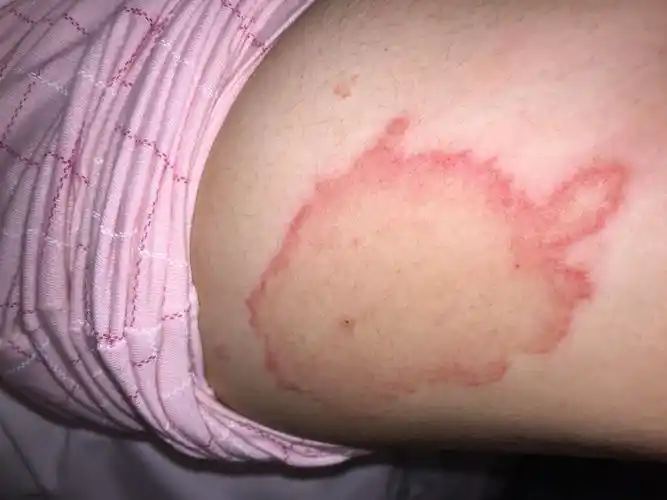 求医!急 症状:骚痒,尤其是遇热,红色部位突出皮肤表面