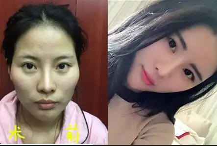 丰太阳穴,丰额头等6项填充恢复图,自体脂肪填充面部前后对比图