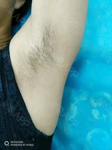 上两天和同事商量想去脱腋毛,这样夏天就可以穿坎袖的_圈子-新氧美容