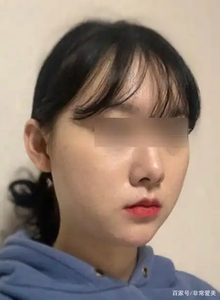 脸大脸宽别怪下颌角,妹子做颧骨效果同样惊艳!