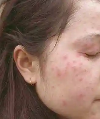 日光性皮炎过敏症状图 - 搜狗图片搜索