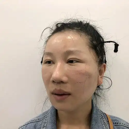 小切口拉皮 人中缩短【术后1周】