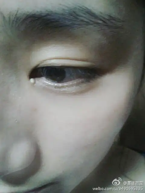眼角长了个尴尬的脂肪粒,谁有好的去除办法?