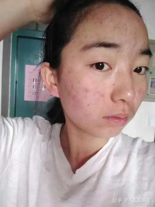 你是怎么从一个皮肤很差的女生改造过来的?