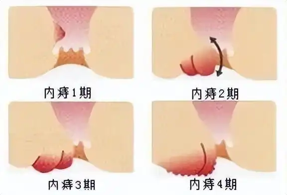 「豫健科普」"对号入座"了解内痔的4个发展时期