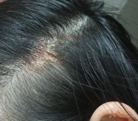 皮肤与性传播疾病讨论版 相关疾病: 皮肤癣菌病 头皮糠疹 头上长癣两