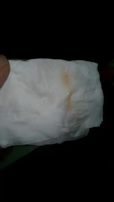 白带有血丝图片44