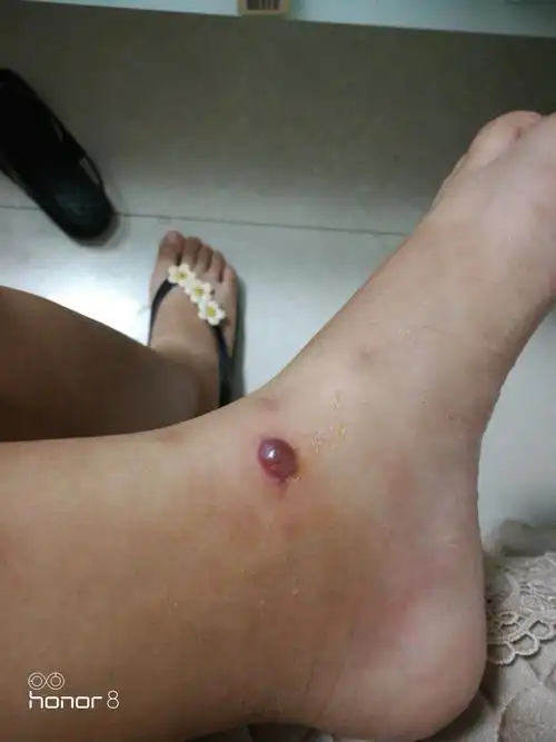 被跳蚤咬的全身都是包是什么样的感受! - 知乎