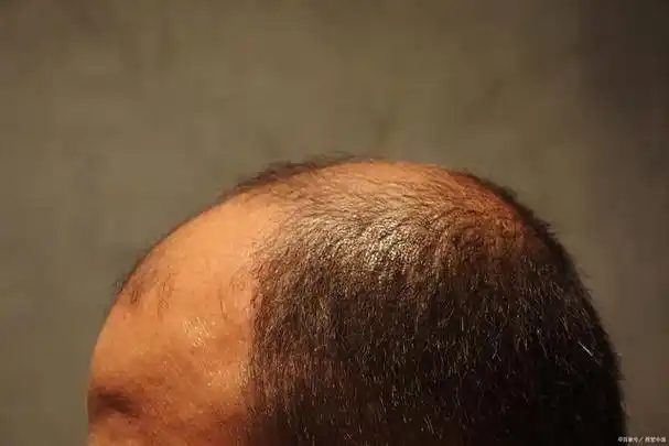 揭秘男性型脱发从初期迹象到发展各阶段及怎样预防