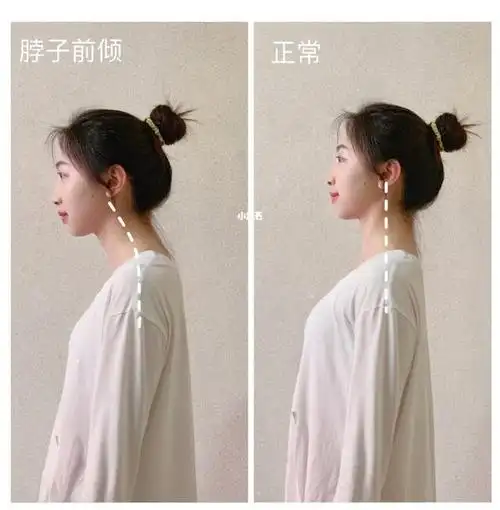 脖子前倾颈部僵硬问题,3分钟教会你颈部前倾如何改善
