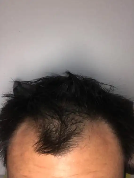 五年前开始脱发,现在前额两角基本脱完了,请问下还能长出头发吗?