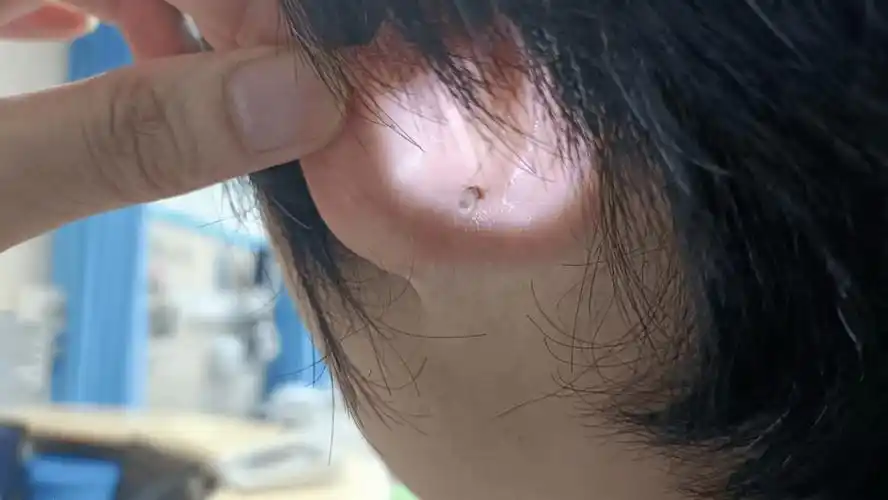 "医生,我儿子今天春游回来之后,耳朵后面突然多了一颗黑痣,又痛又痒