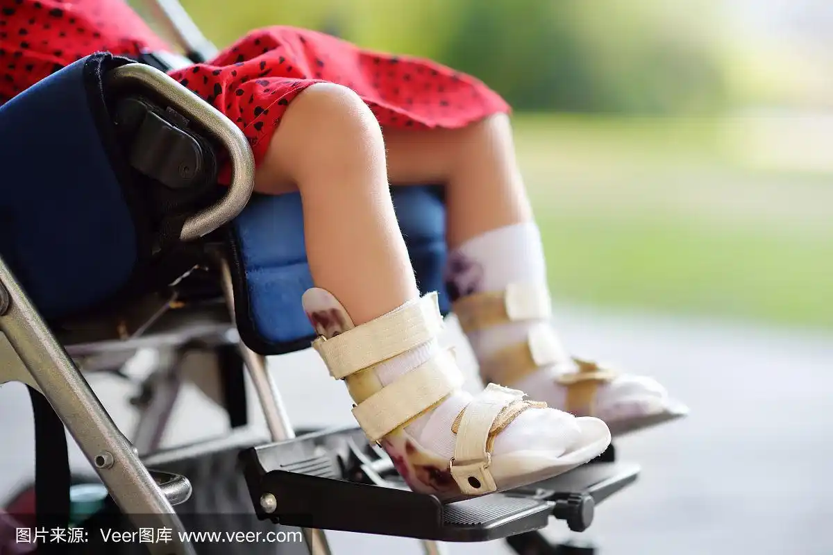 坐在轮椅上的残疾女孩.她腿上的矫形设备.儿童脑瘫.包容.