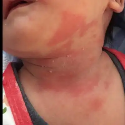 宝宝是不是奶粉过敏了啊?越来越多红处应该怎么办呢?