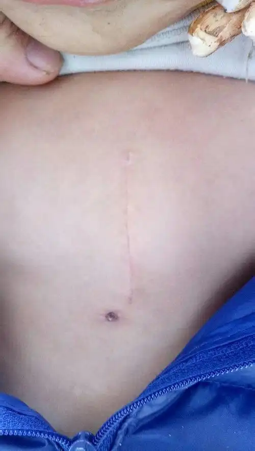 胸骨下段小切口 - 好大夫在线