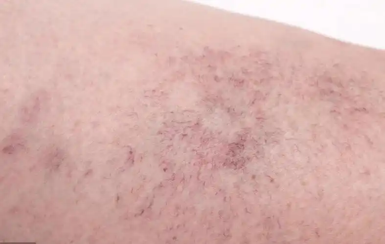 肝癌并不是悄无声息这三种症状一出现去查查肝功