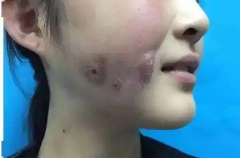 嘴角_整形_脂肪