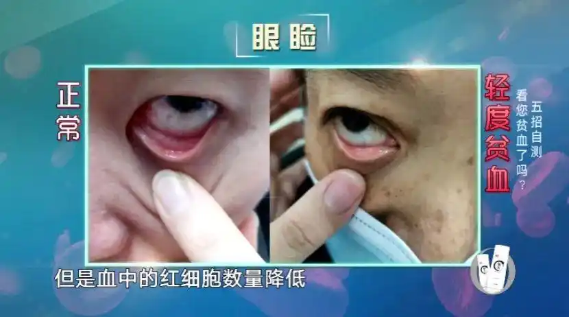 贫血背后隐藏的危机你知道吗