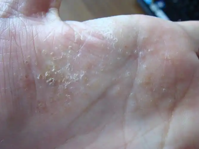 什么是鹅掌风 你知道鹅掌风怎么治疗吗