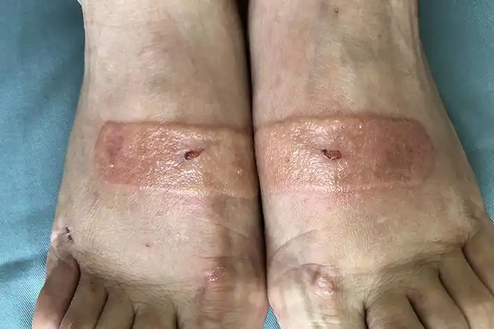 呈红斑,丘疹,丘疱疹,肿胀,水疱,大疱甚至坏死等