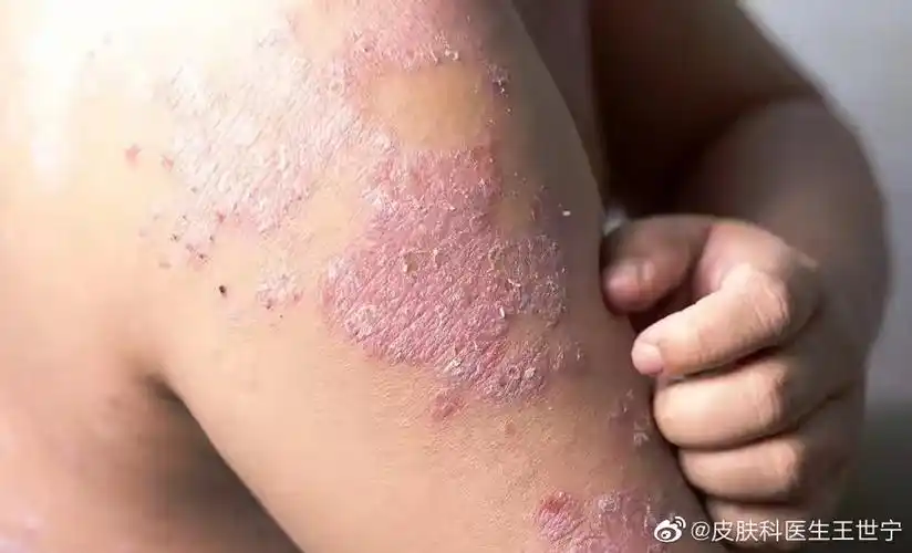 这几种皮肤病千万不要抽烟了